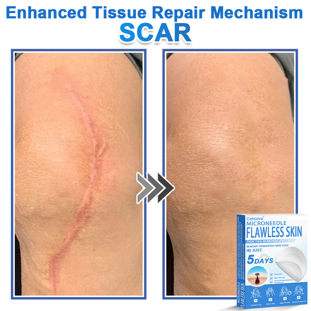 👨⚕️ Celsiora® 2-in-1 Microneedle & Hydrocolloid Patch | Raised Moles,Acne, Flat Warts & Skin Tags Remover | Improves Wrinkles, Scars & Blemishes | Invisible Pimple Patches for Face & Body