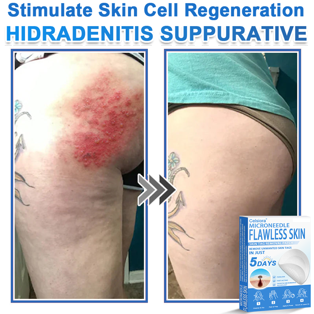 👨‍⚕️ Celsiora® 2-in-1 Microneedle & Hydrocolloid Patch | Raised Moles,Acne,  Flat Warts & Skin Tags Remover | Improves Wrinkles, Scars & Blemishes | Invisible Pimple Patches for Face & Body