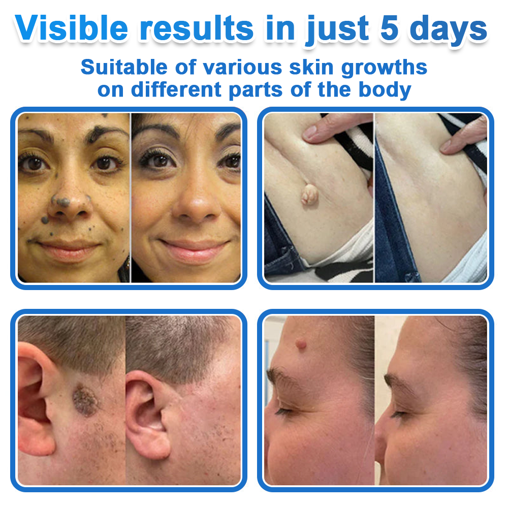 👨‍⚕️ Celsiora® 2-in-1 Microneedle & Hydrocolloid Patch | Raised Moles,Acne,  Flat Warts & Skin Tags Remover | Improves Wrinkles, Scars & Blemishes | Invisible Pimple Patches for Face & Body