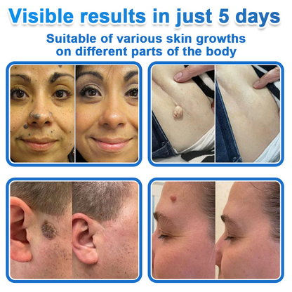 👨‍⚕️ Celsiora® 2-in-1 Microneedle & Hydrocolloid Patch | Raised Moles,Acne,  Flat Warts & Skin Tags Remover | Improves Wrinkles, Scars & Blemishes | Invisible Pimple Patches for Face & Body