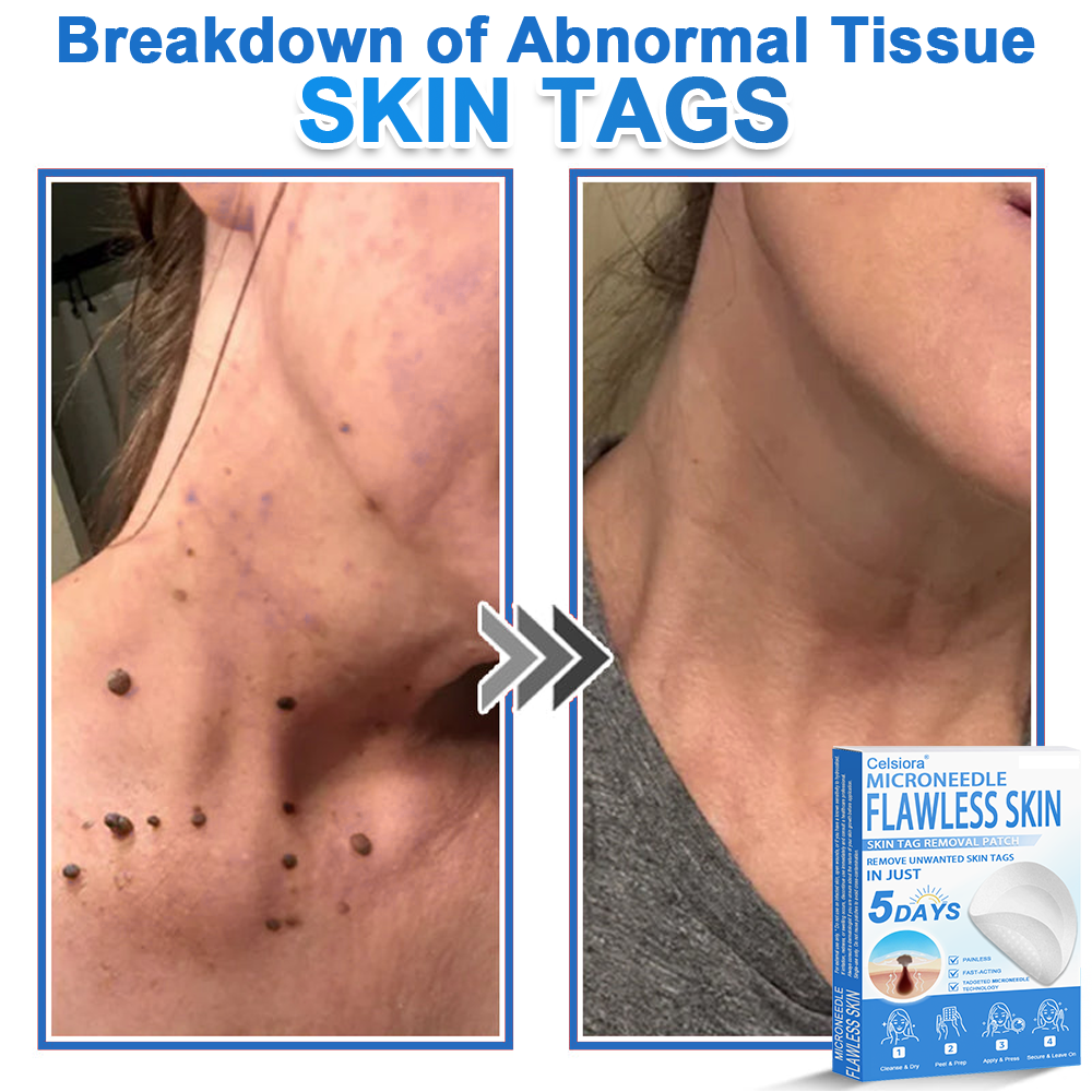 👨‍⚕️ Celsiora® 2-in-1 Microneedle & Hydrocolloid Patch | Raised Moles,Acne,  Flat Warts & Skin Tags Remover | Improves Wrinkles, Scars & Blemishes | Invisible Pimple Patches for Face & Body