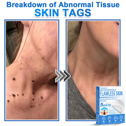 👨‍⚕️ Celsiora® 2-in-1 Microneedle & Hydrocolloid Patch | Raised Moles,Acne,  Flat Warts & Skin Tags Remover | Improves Wrinkles, Scars & Blemishes | Invisible Pimple Patches for Face & Body