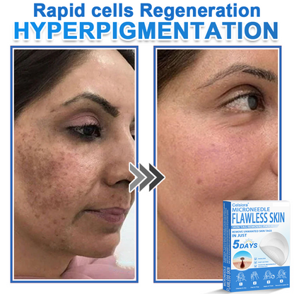 👨‍⚕️ Celsiora® 2-in-1 Microneedle & Hydrocolloid Patch | Raised Moles,Acne,  Flat Warts & Skin Tags Remover | Improves Wrinkles, Scars & Blemishes | Invisible Pimple Patches for Face & Body